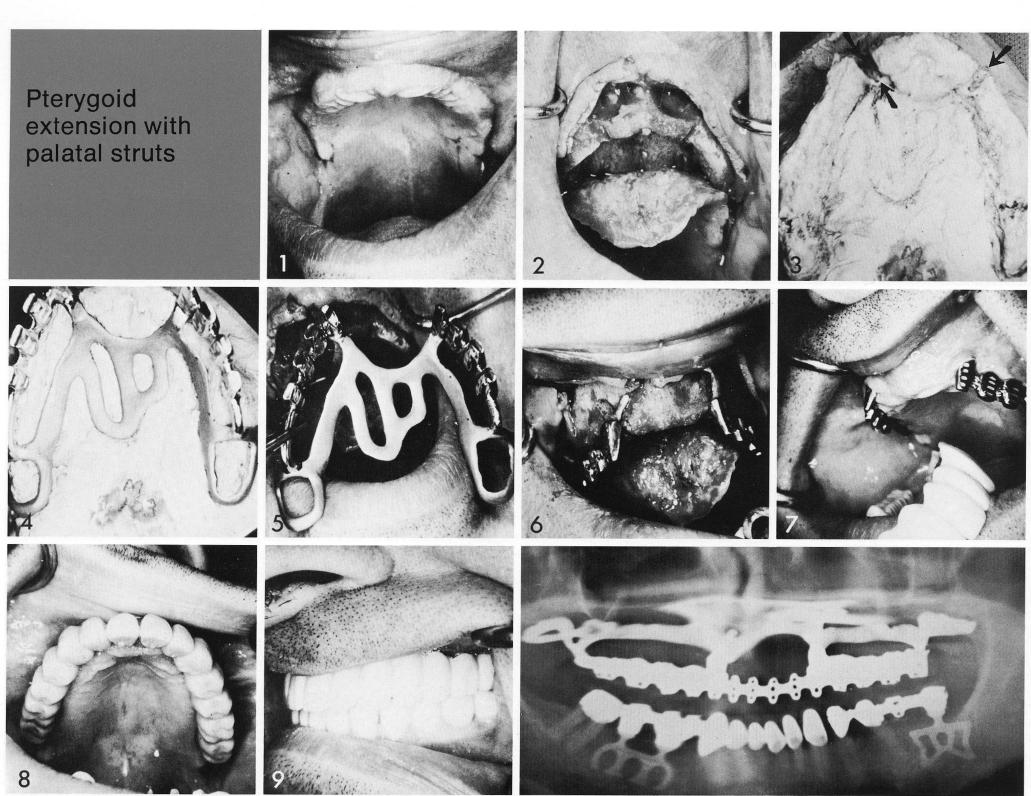 1 Very severely maxillary anterior ridge undercut for implantation