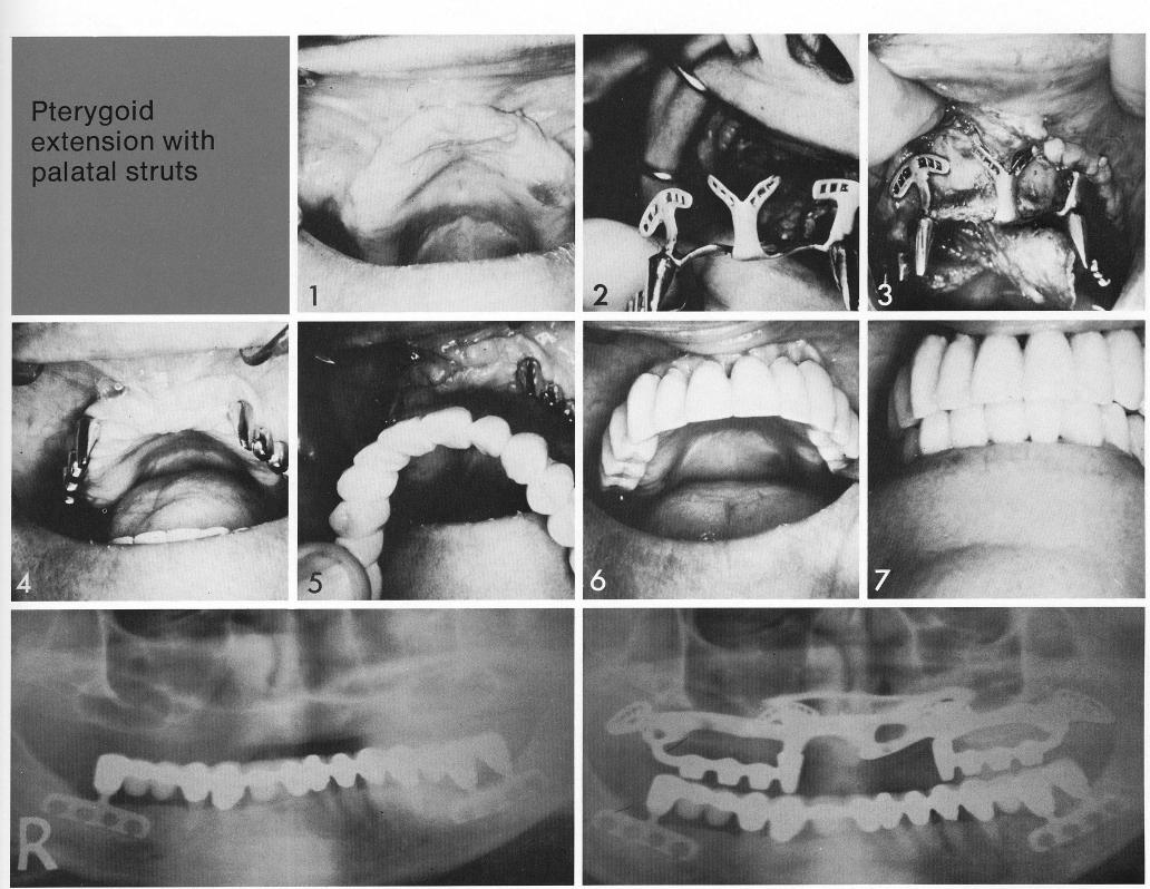 1 Unusual anterior portion of maxillary pterygoid extension implant