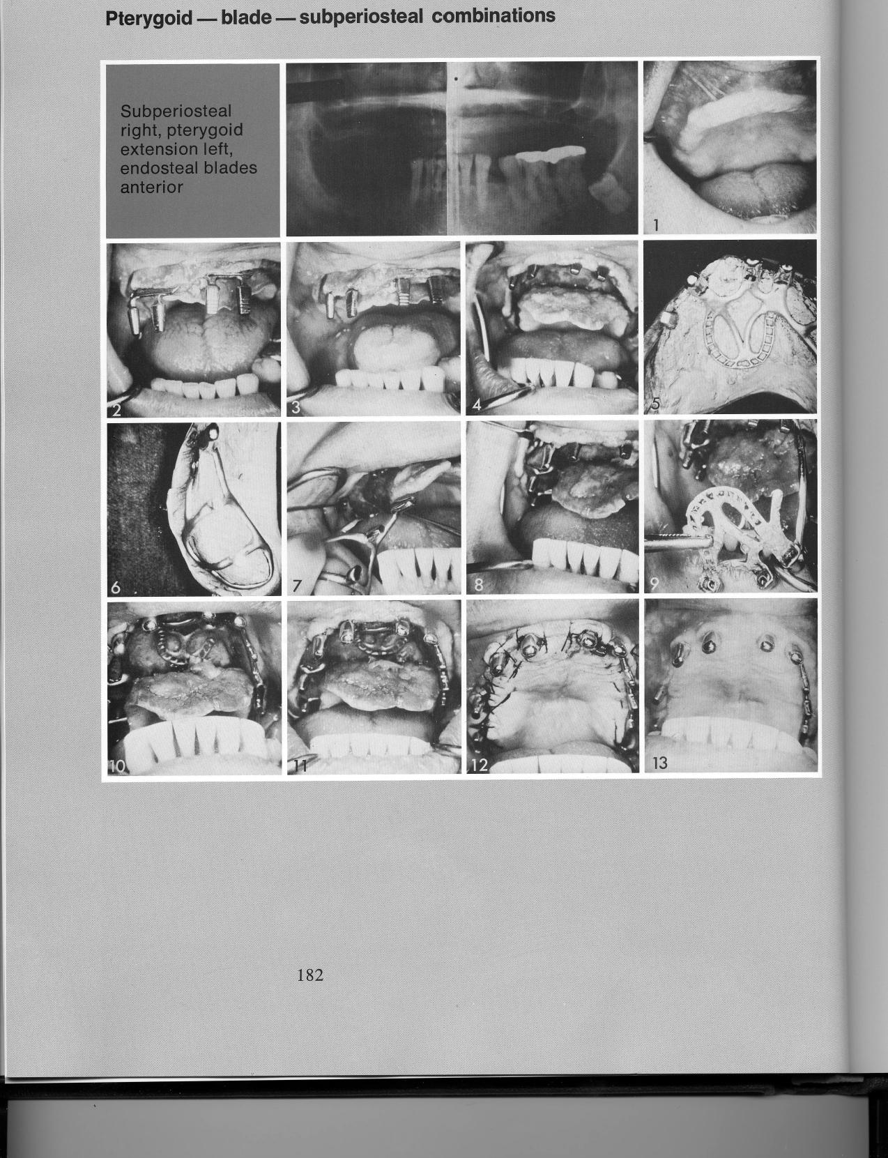 1 Double posted bladevent implant as anchorage for subperiosteal implants