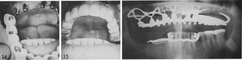 1 Full maxillary arch restoration cemented over abutment implant posts