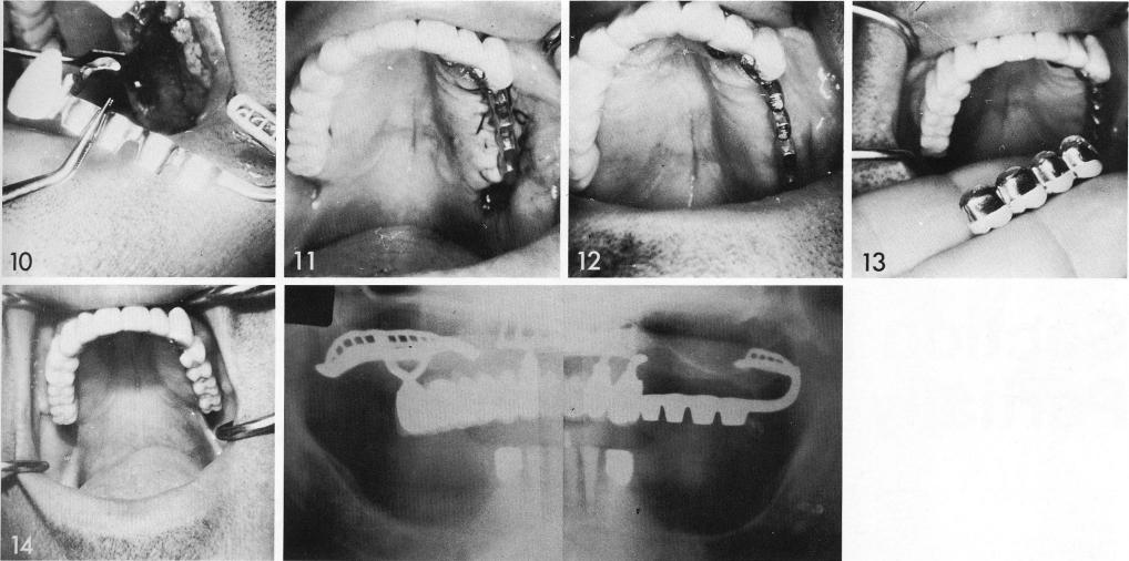 1 The maxillary ridges exposed for the pterygoid extension implant 