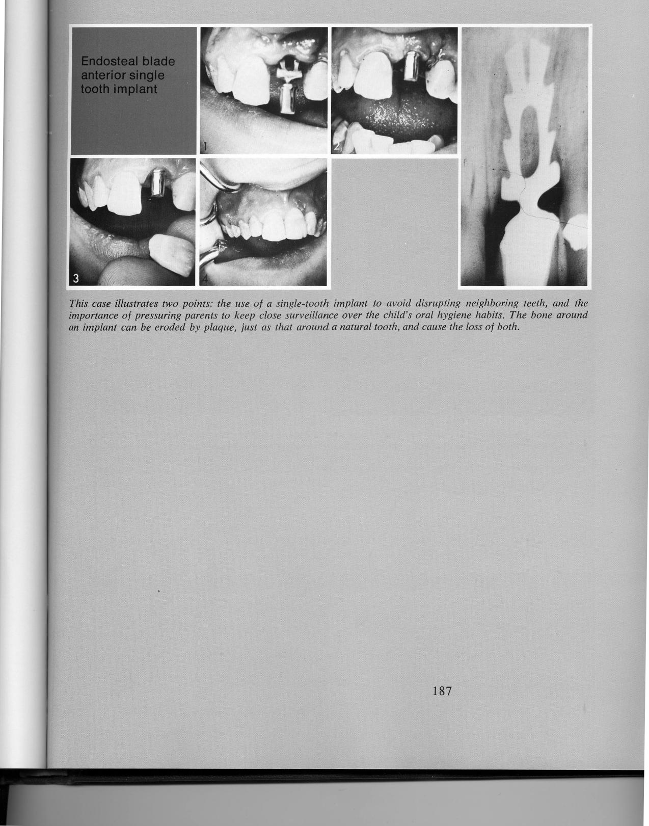 1 Maxillary tooth implant use to avoid disrupting the neighboring teeth