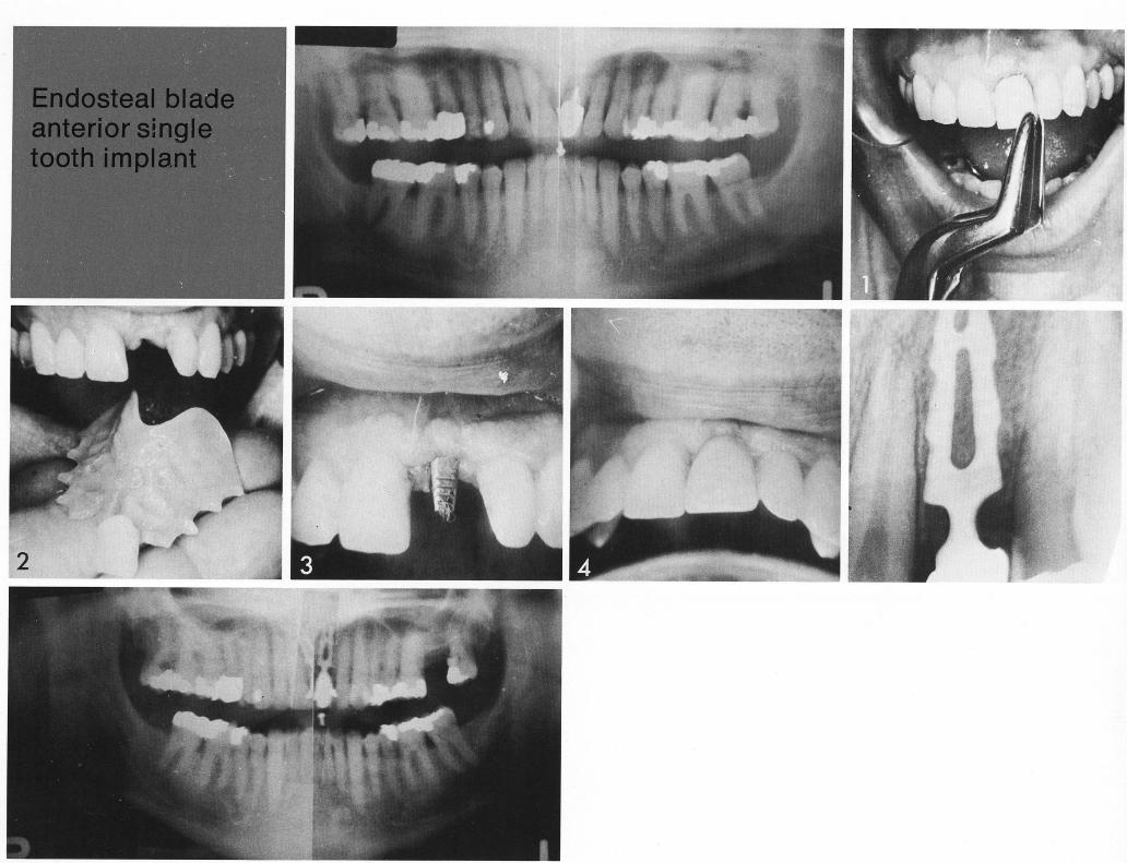 1 Single maxillary tooth implant provides a stable abutment in good bone 