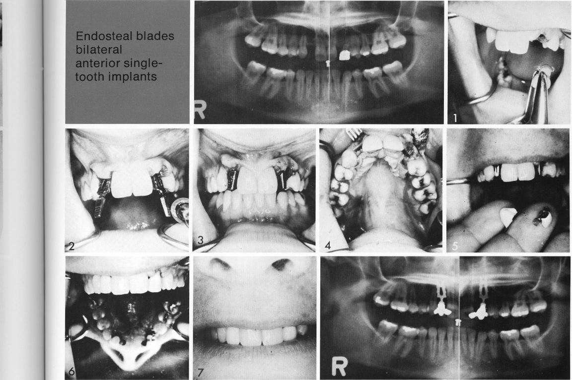 1 The patient with space for only a single maxillary tooth replacement