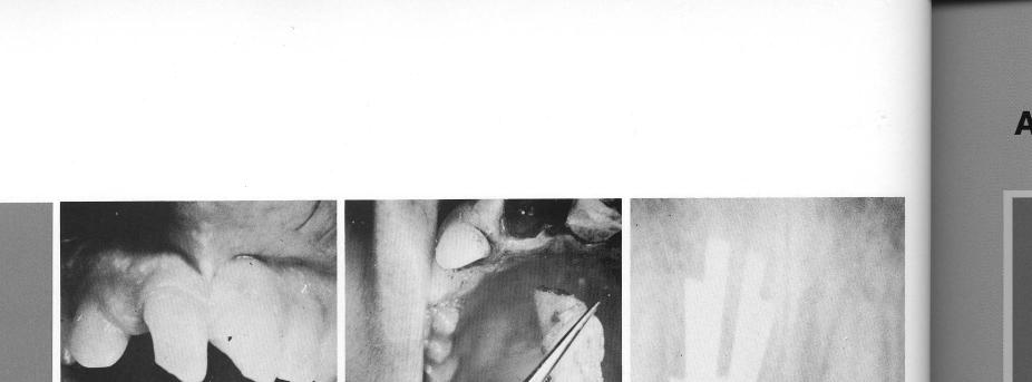 1 Two unit maxillary restoration for patient with diastemas and esthetics