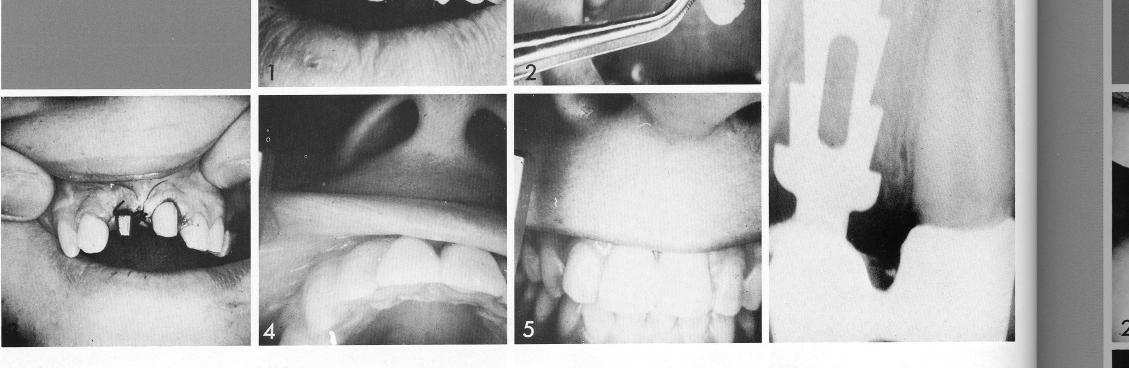 2 Maxillary tooth bladevent implant inserted deep beyond shallow socket
