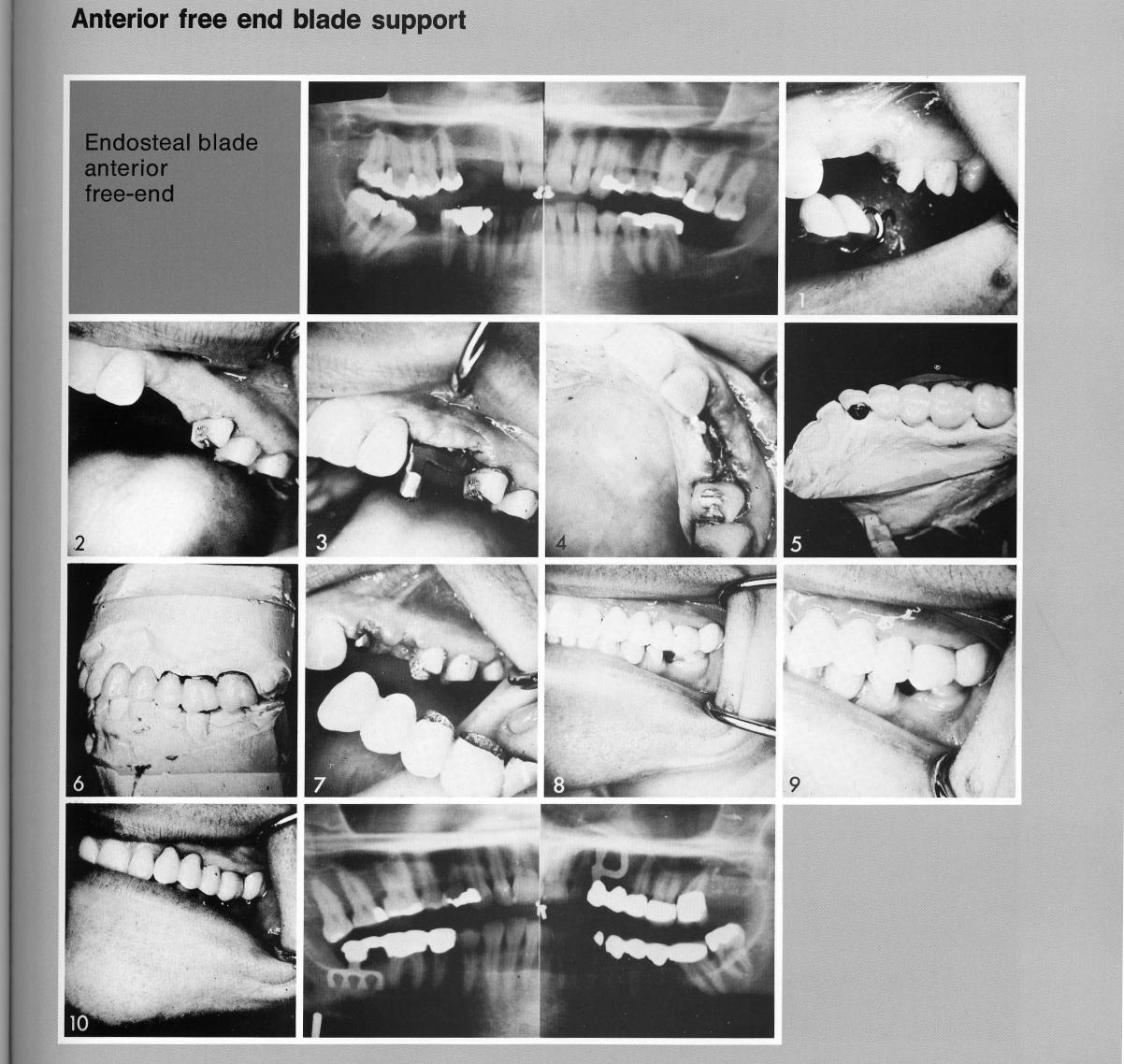 1 Maxillary anterior tooth`s crown saved by use of a bladevent implant