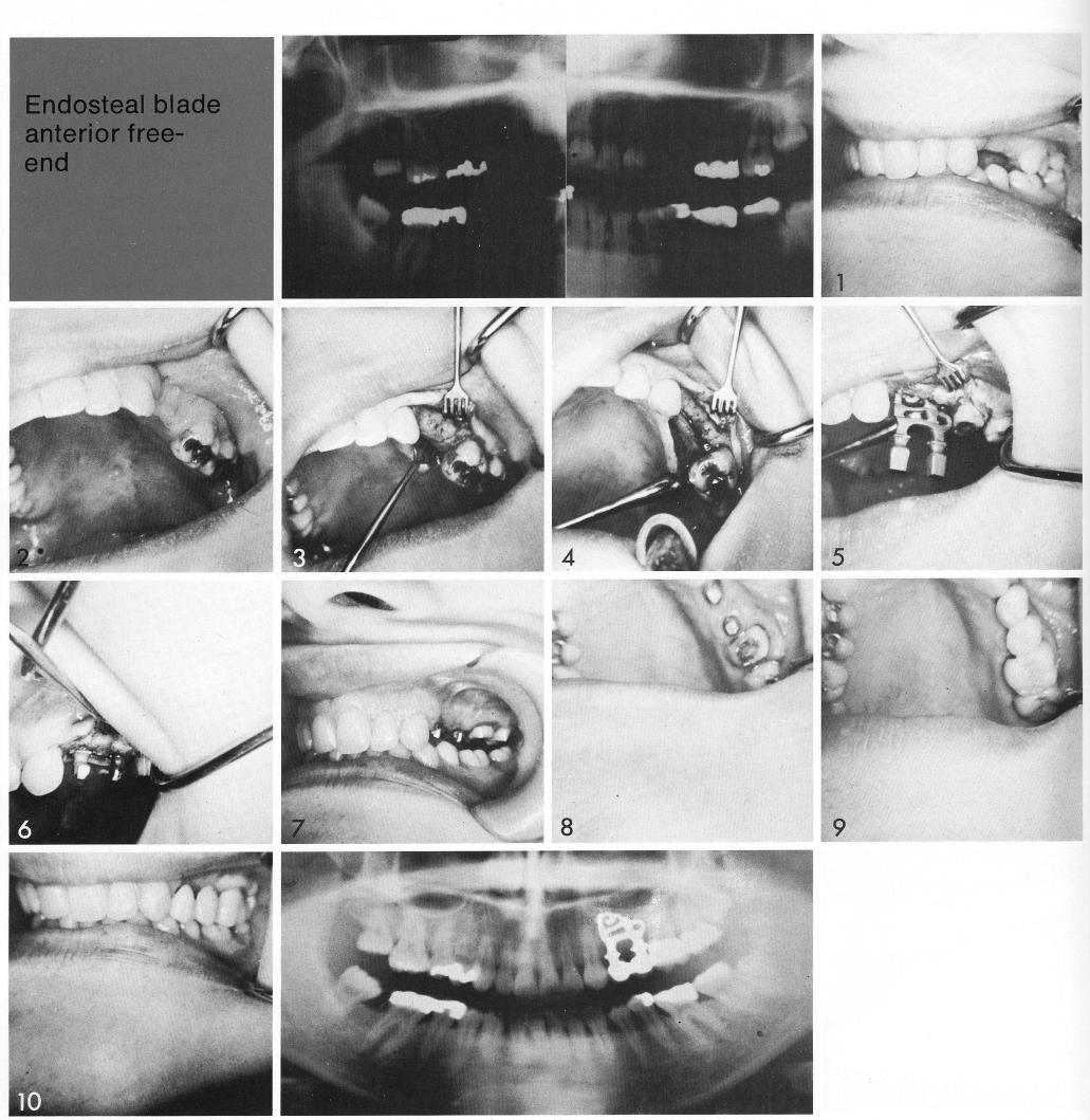 1 Maxillary double posted bladevent implant inserted in a large gap area