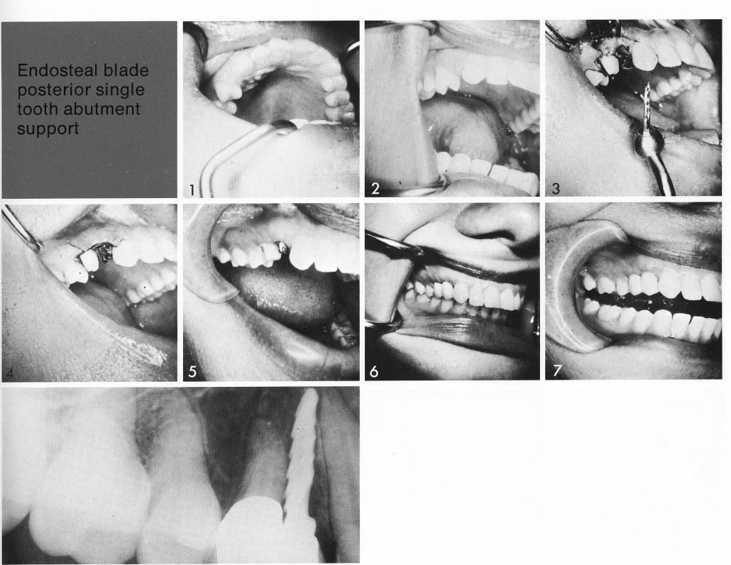 1 Large diastema between maxillary canine and the first bicuspid