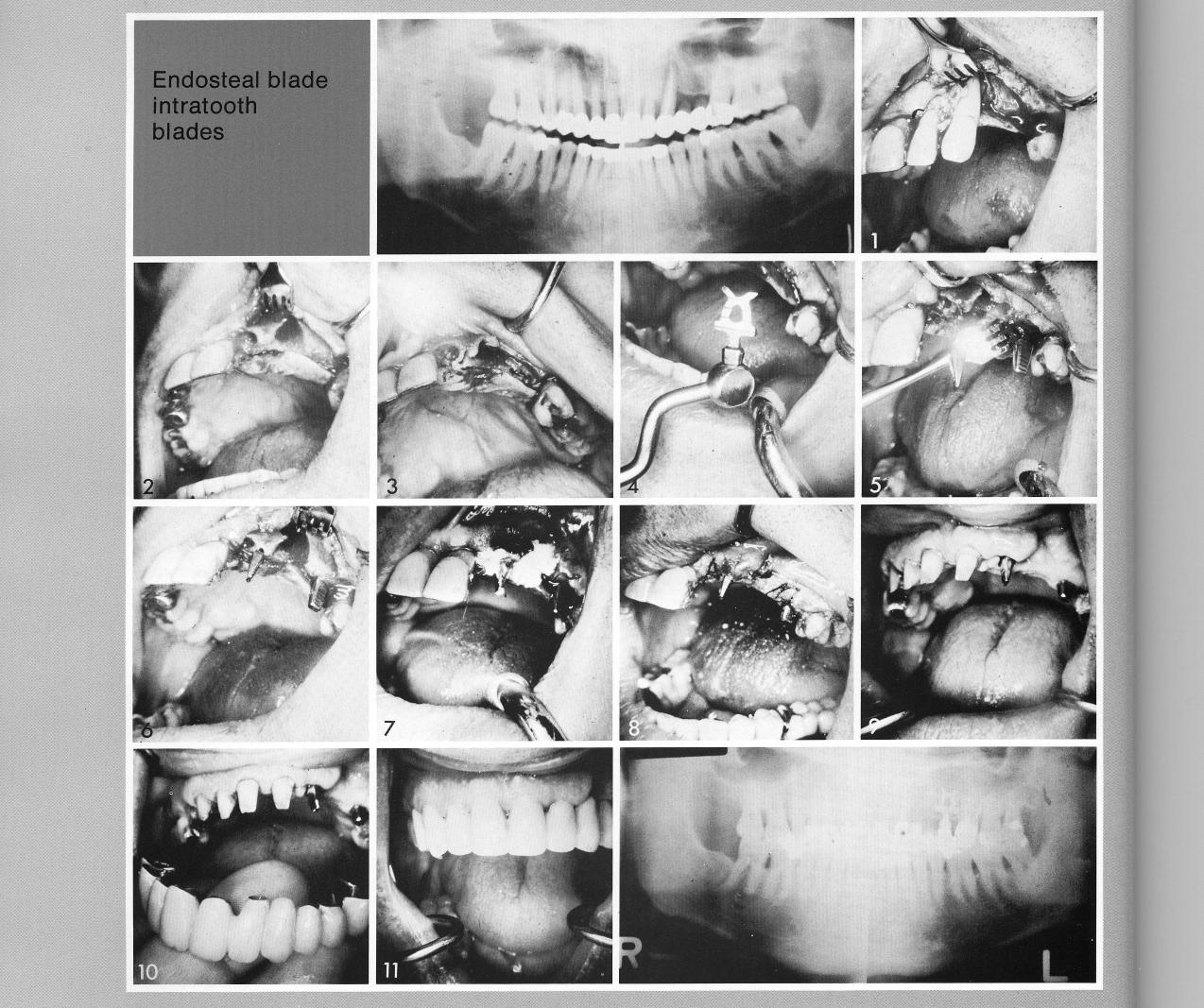 1 A trimmed maxillary bladevent implant seated