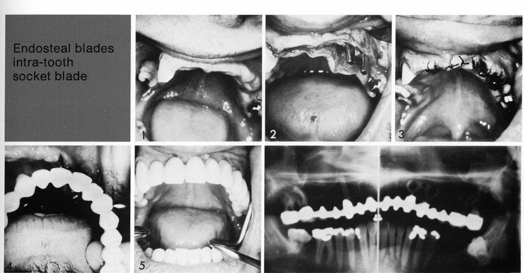 1 Maxillary double posted bladevent implant used in a single site 