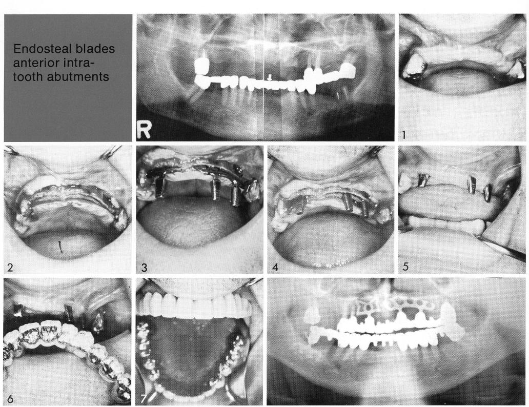 1 Narrow maxillary ridge for implantation