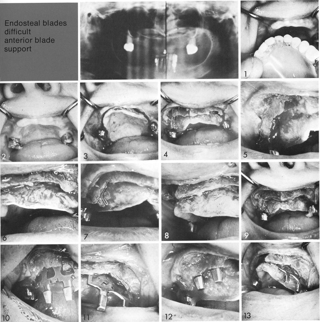 1 Maxillary ridge needs considerable work before using bladevent implants