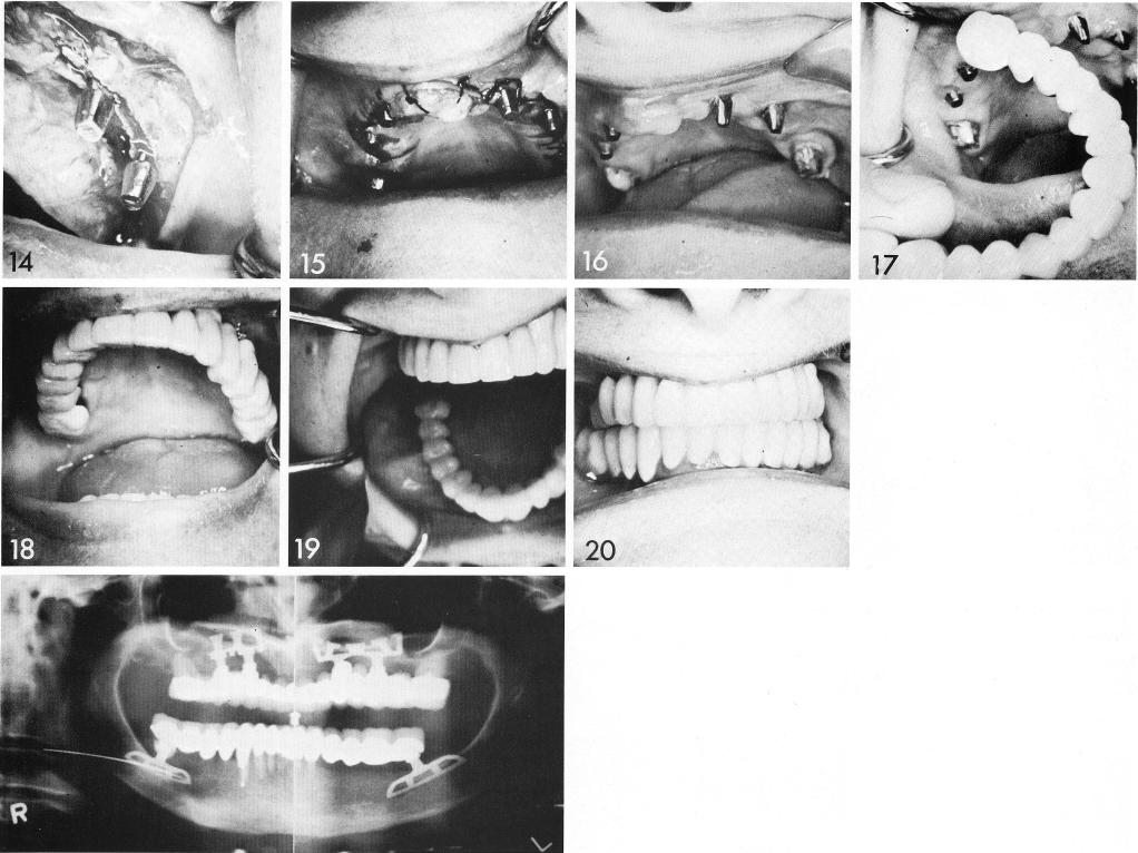 1 Anterior and posterior maxillary abutments in prosthesis