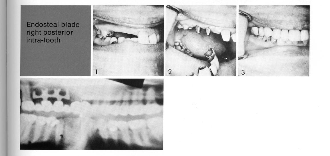 1 Open socket maxillary bladevent implant used