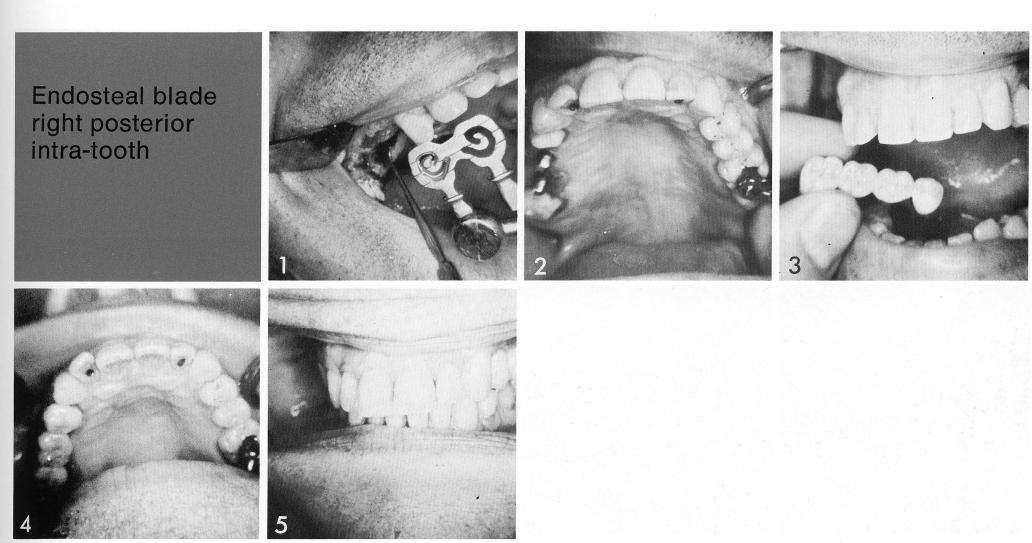 2 Four unit maxillary restoration cemented with hard cement over implants