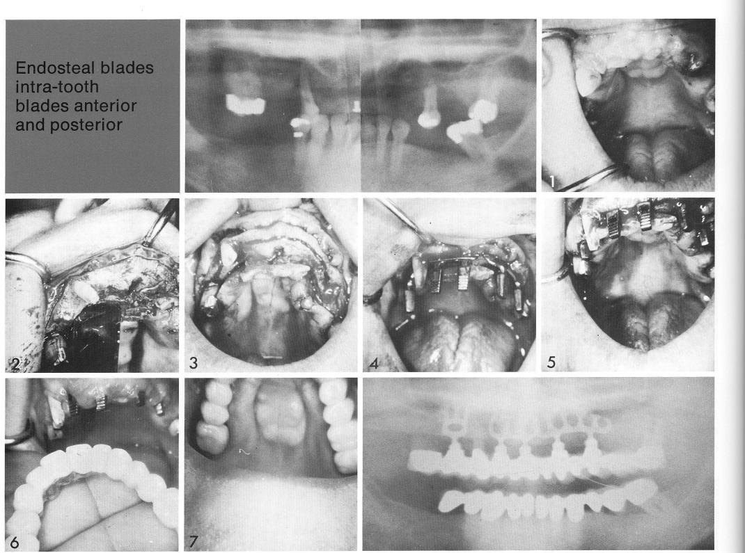 1 Partially edentulous patient with unusually wide maxillary ridge