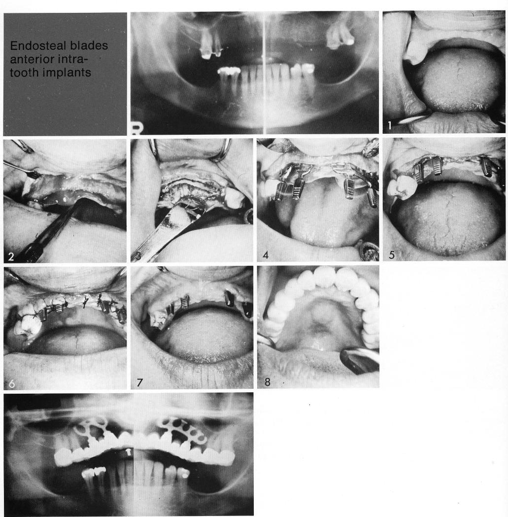 1 The revealed maxillary ridge reduced for bladevent implants insertion