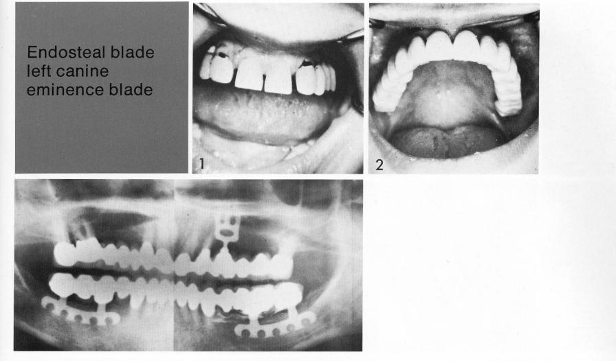 1 The maxillary bladevent implant inserted in the cuspid area