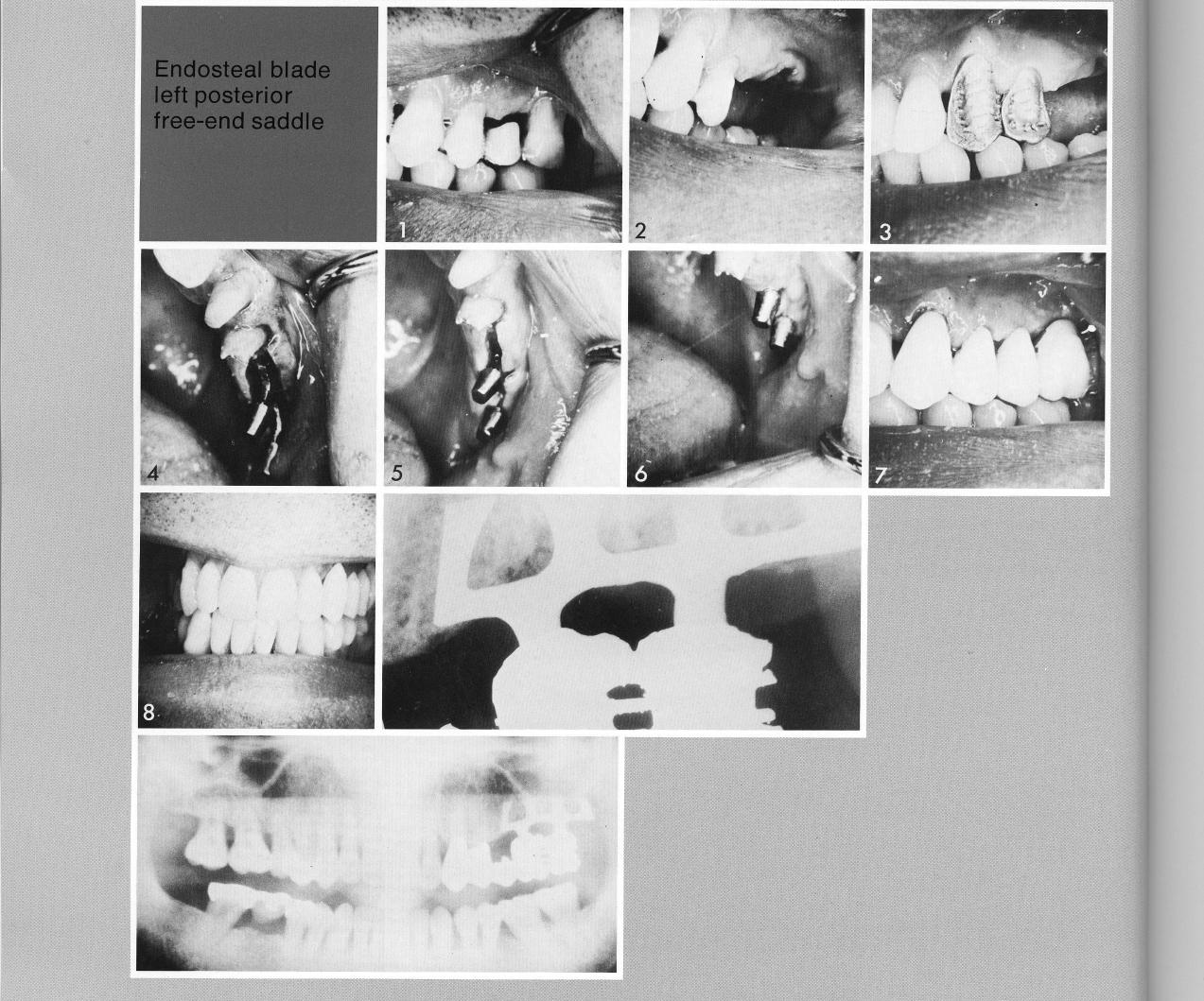 2 A double posted maxillary bladevent implant inserted