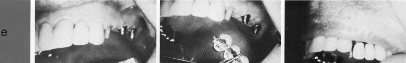 1 Enough bone below maxillary sinus for double posted bladevent implant