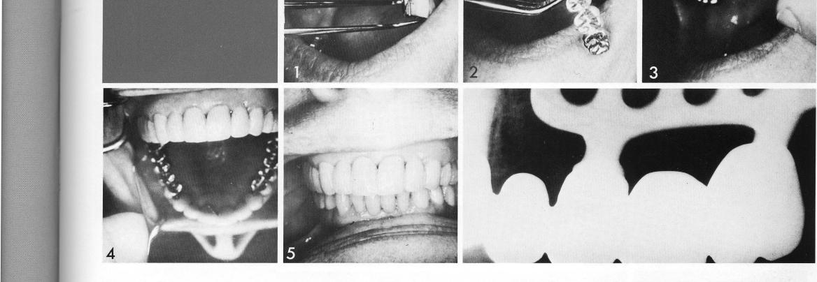 2 The three quarter maxillary arch restoration over implants