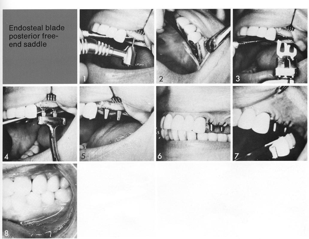 1 A deep bodied bladevent implant set in front of the maxillary sinus 