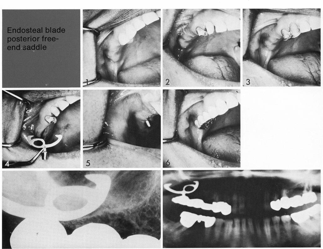 1 Special maxillary sinus circumventing bladevent implant