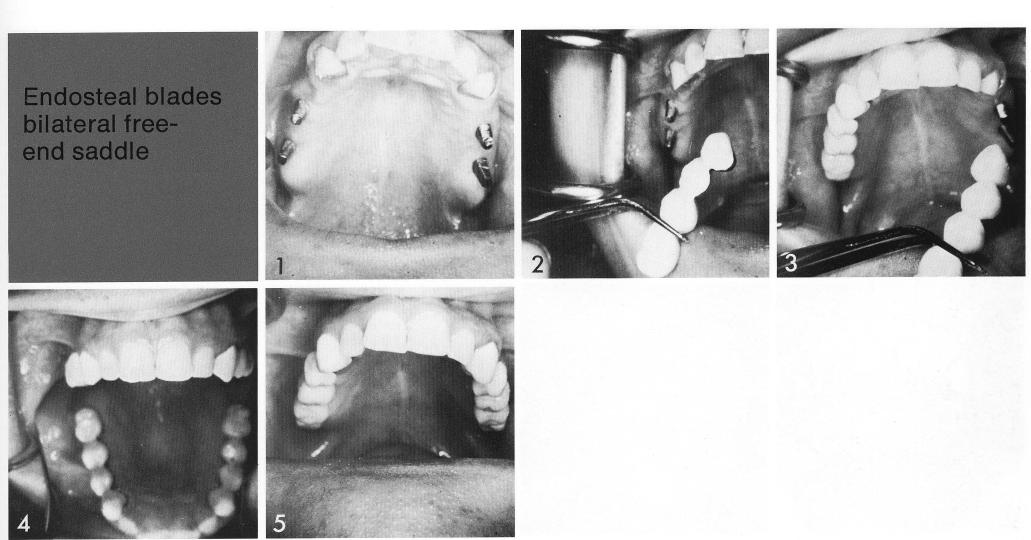 1 well supported anterior and bilaterally maxillary edentulous spans