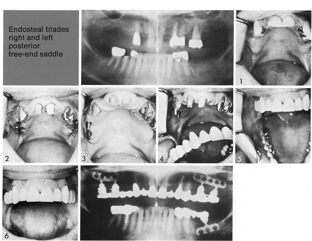 1 Maxillary bladevent implant customized to accommodate low drop in sinus