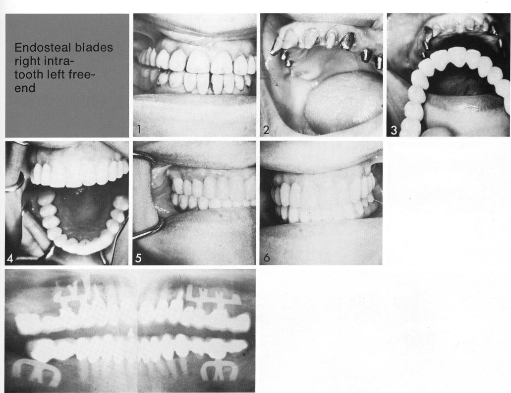 1 Maxillary sinus circumventing bladevent implants used bilaterally