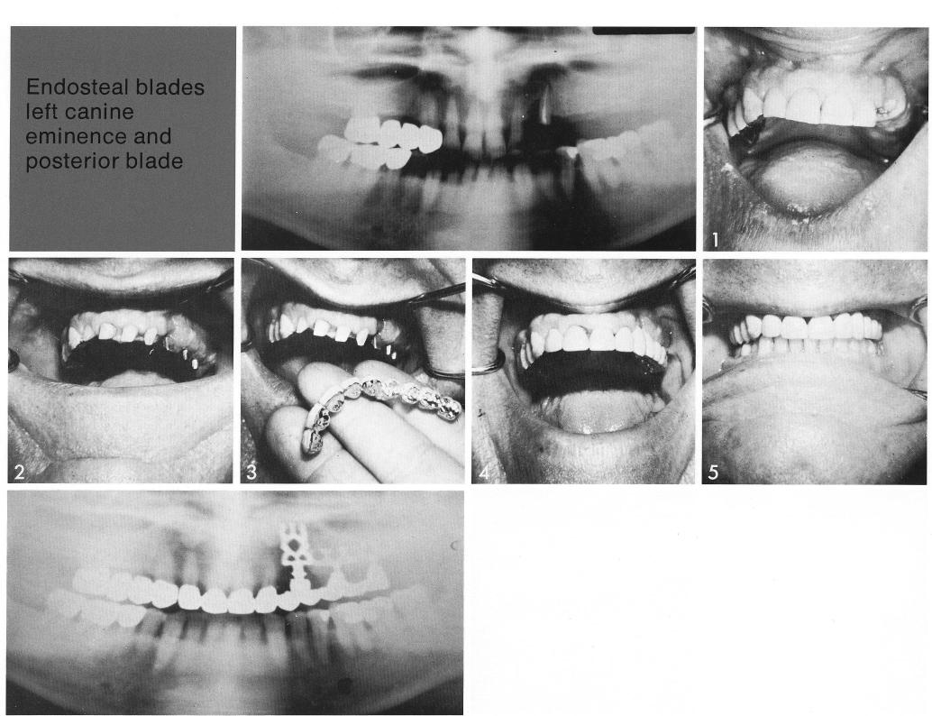 1 Seating a maxillary bladevent implant deep within the canine pillar