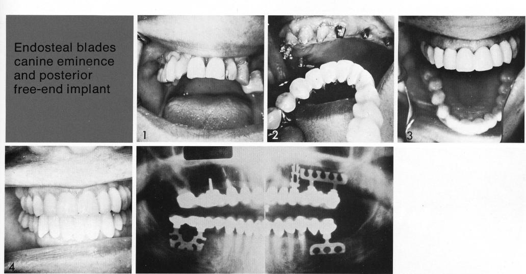 1 Single maxillary tooth bladevent implant