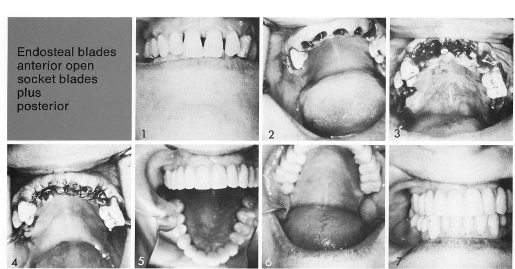 1 Loose maxillary anterior teeth
