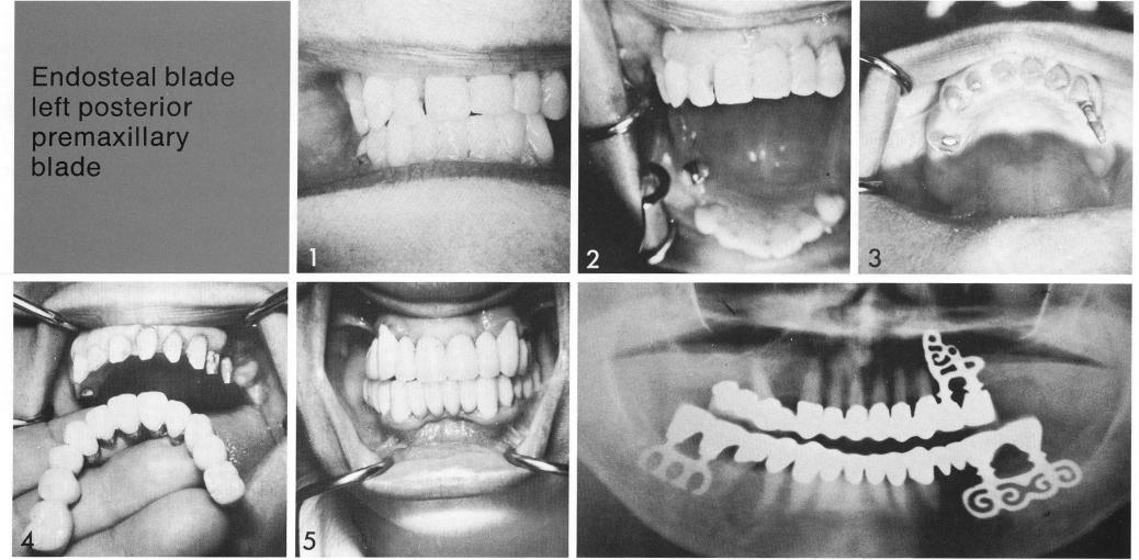 2 An open socket maxillary bladevent implant used anteriorly