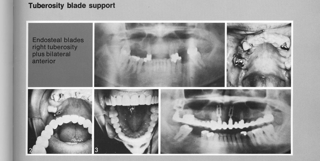 1 Single maxillary tooth bladevent implant seated in tuberosity region