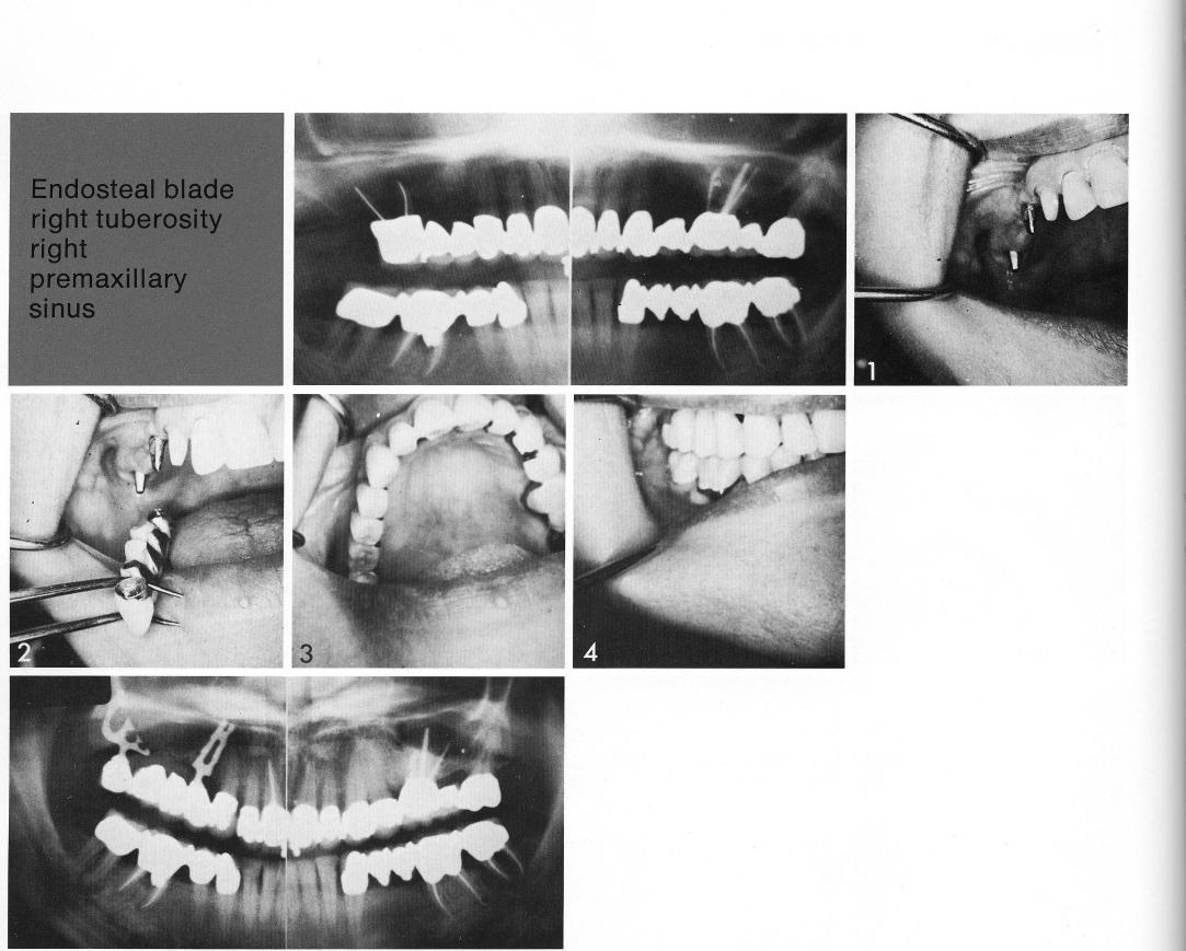 1 Two bladevent implants used in a long maxillary edentulous span