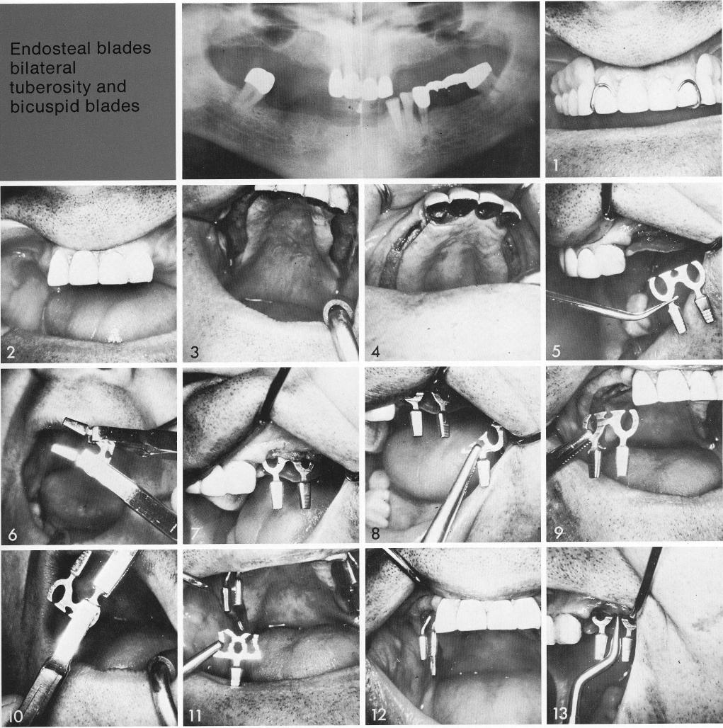1 Bilaterally maxillary edentulous posterior free ends for implantation