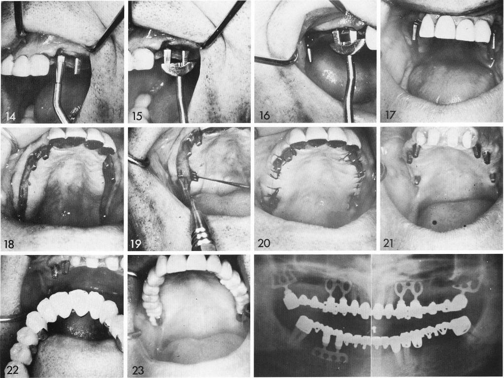 1 All maxillary bladevent implants are properly seated