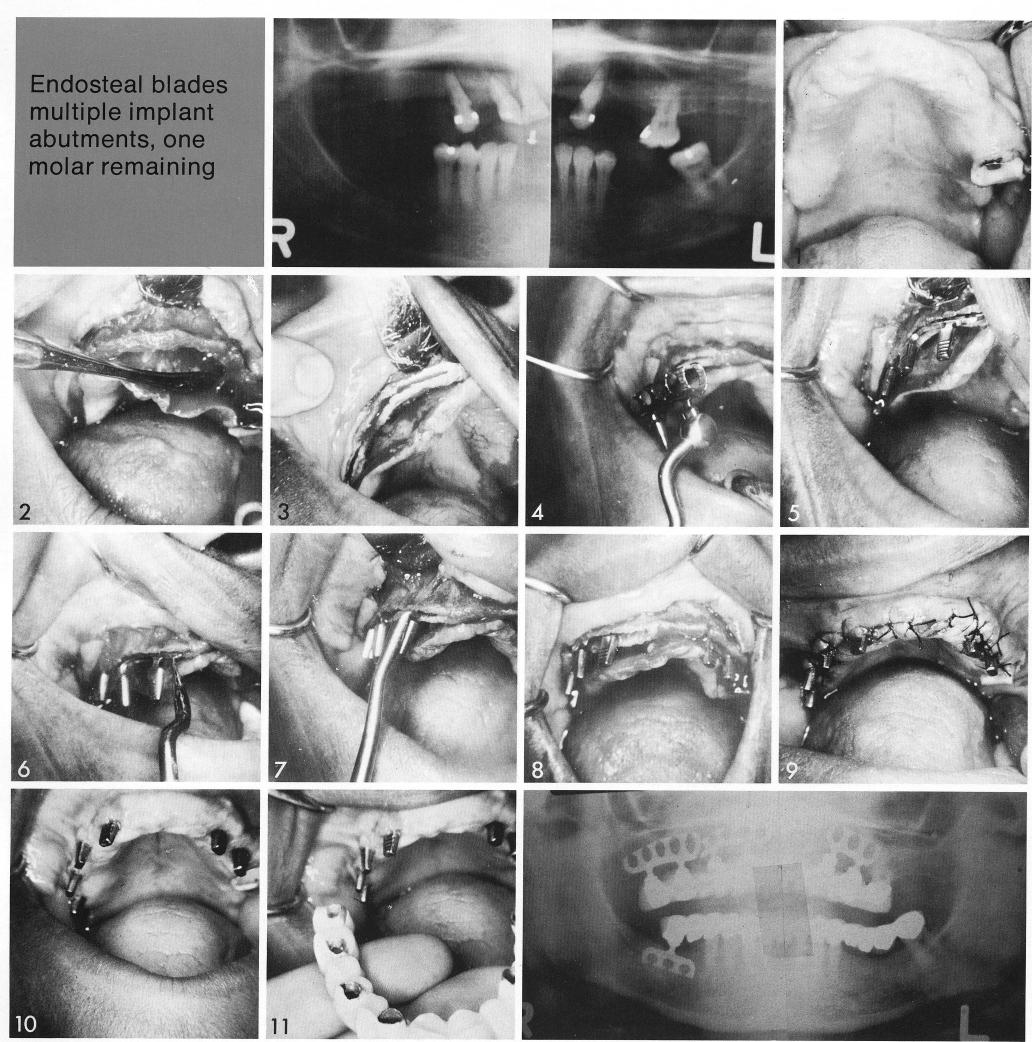 1 Thick maxillary ridge with severe undercut for implantation