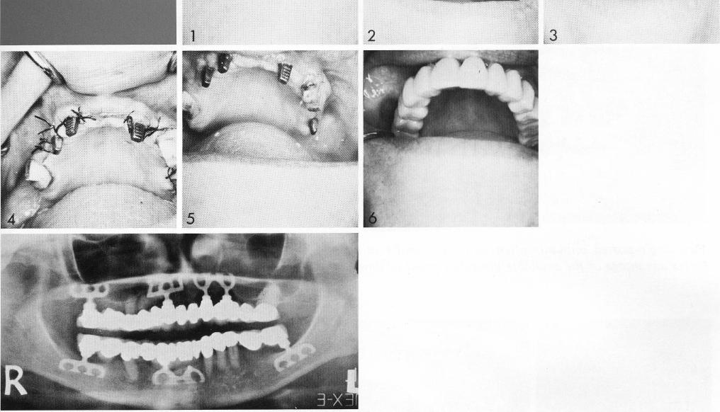 3 An open socket maxillary bladevent implant used  