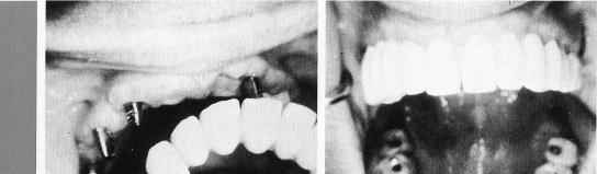 1 Single maxillary tooth implant is inserted in arch