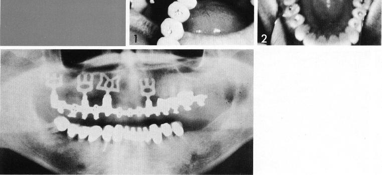 2 Maxillary implant abutments provide support for four unit restoration 