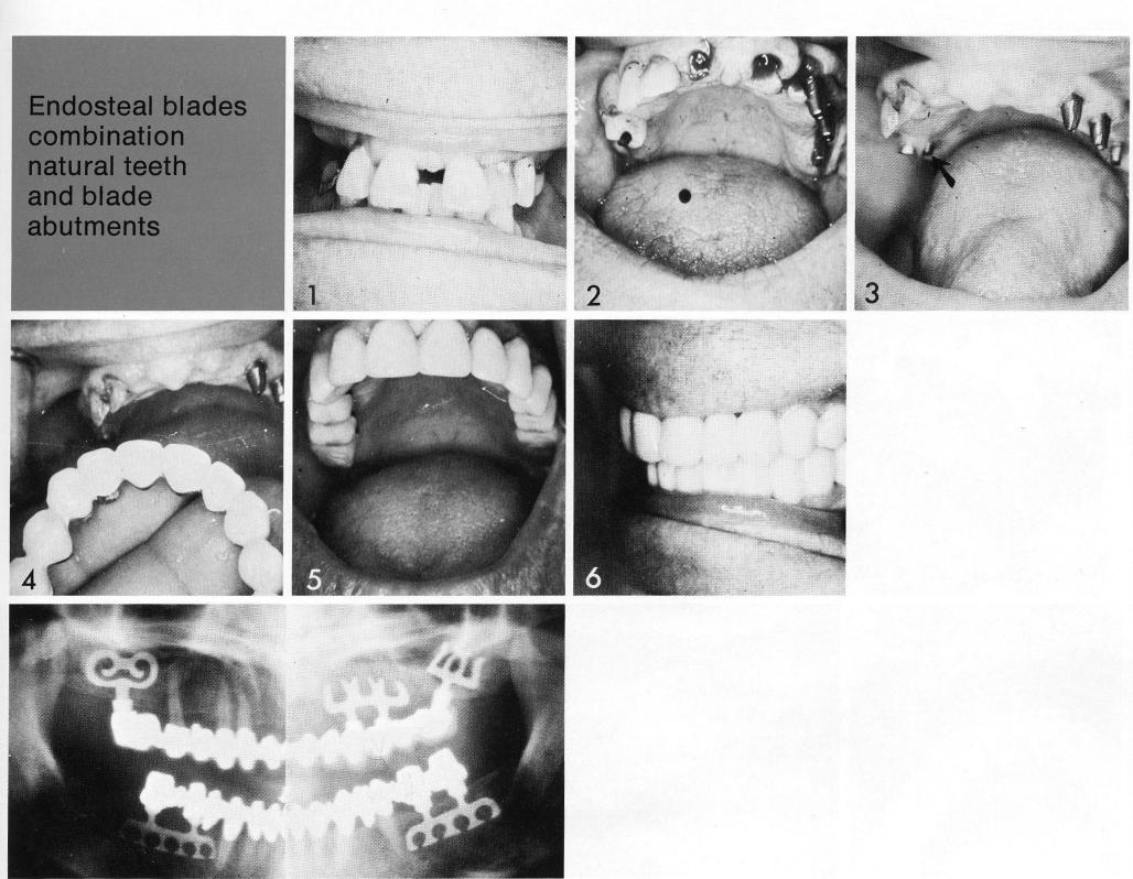 1 Bladevent implants provide support for a maxillary fixed prosthesis 