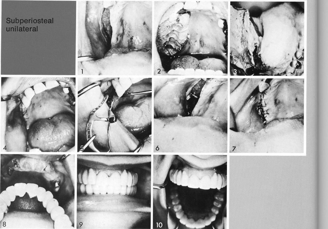 1 A maxillary subperiosteal implant inserted