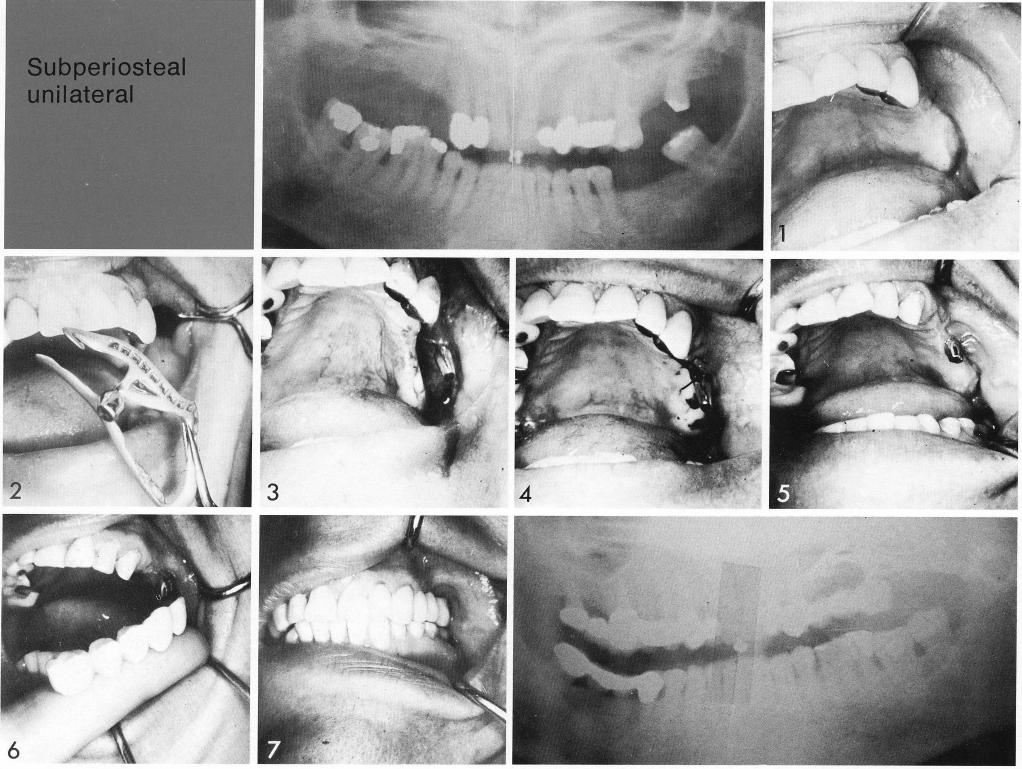 1 The maxillary subperiosteal implant used as a posterior anchorage