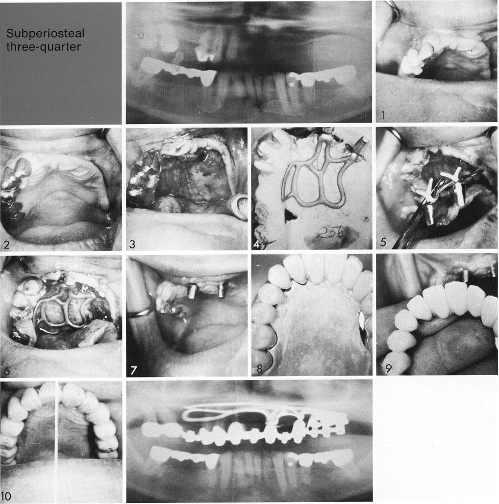 1 Modified toroplant used when stable maxillary natural teeth included