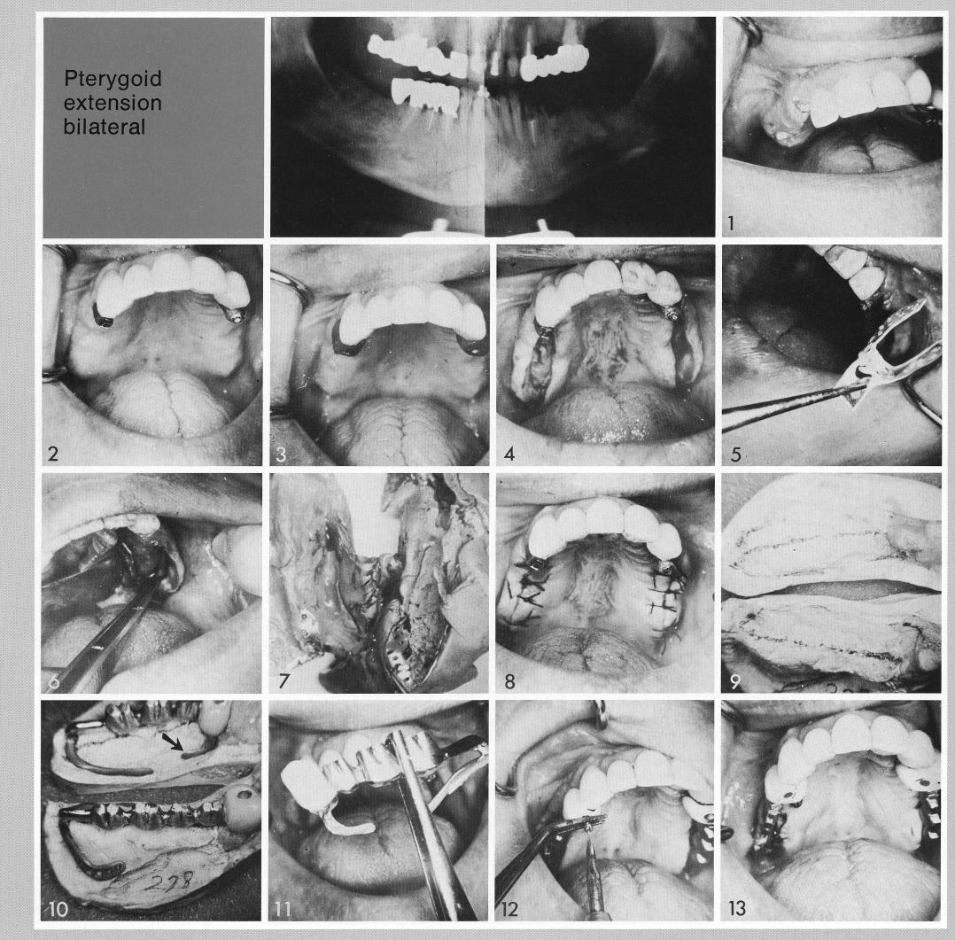 1 Old design maxillary implants with a palatal finger used