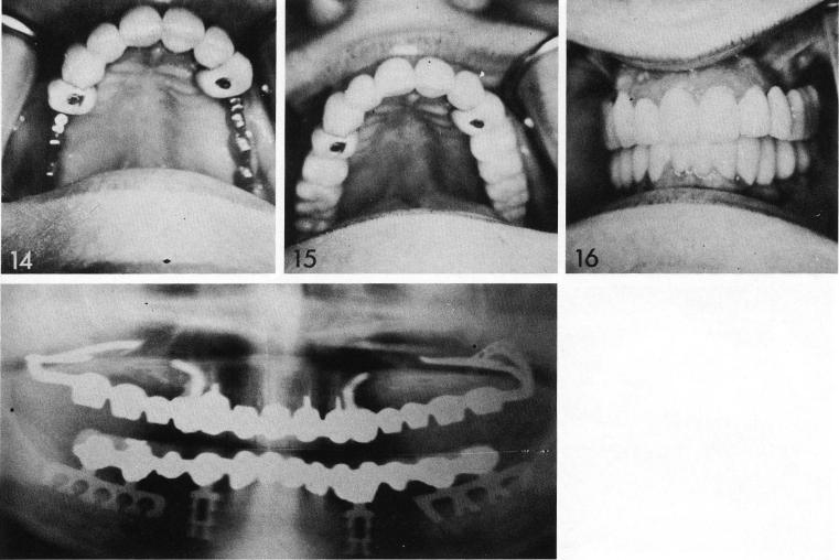 1 Bulky anchorage maxillary crowns for implants