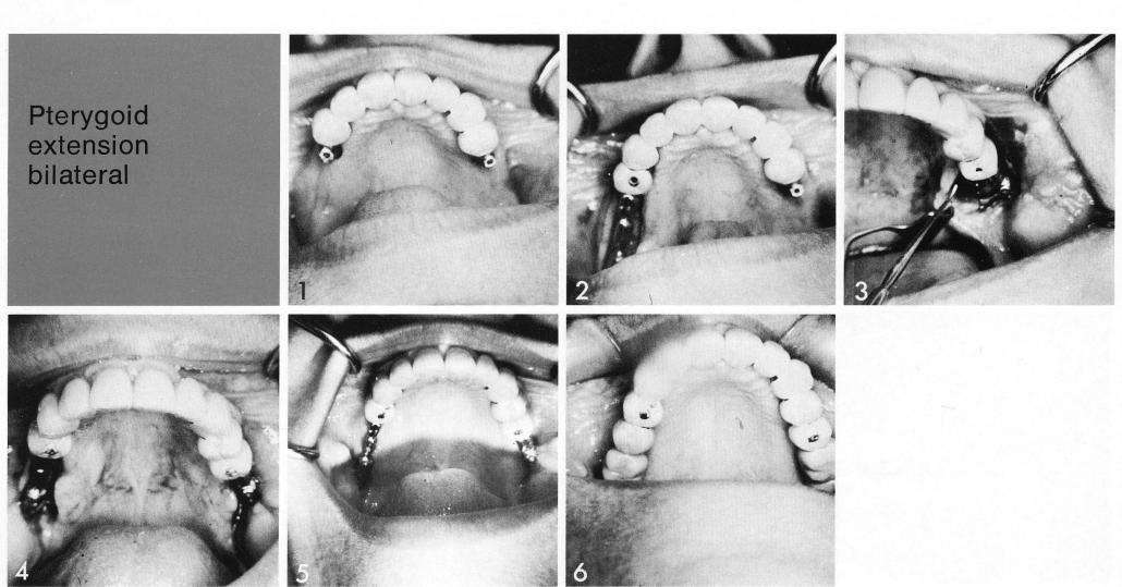 1 Case showing a maxillay pterygoid extension implant